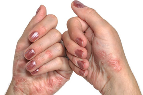 psoriasis on the hairline and on the scalp