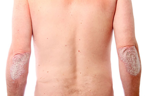 psoriasis on the hairline and on the scalp