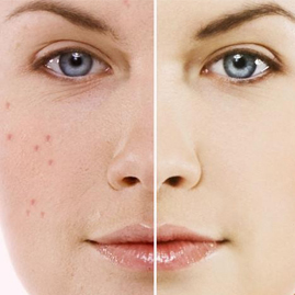 acne1